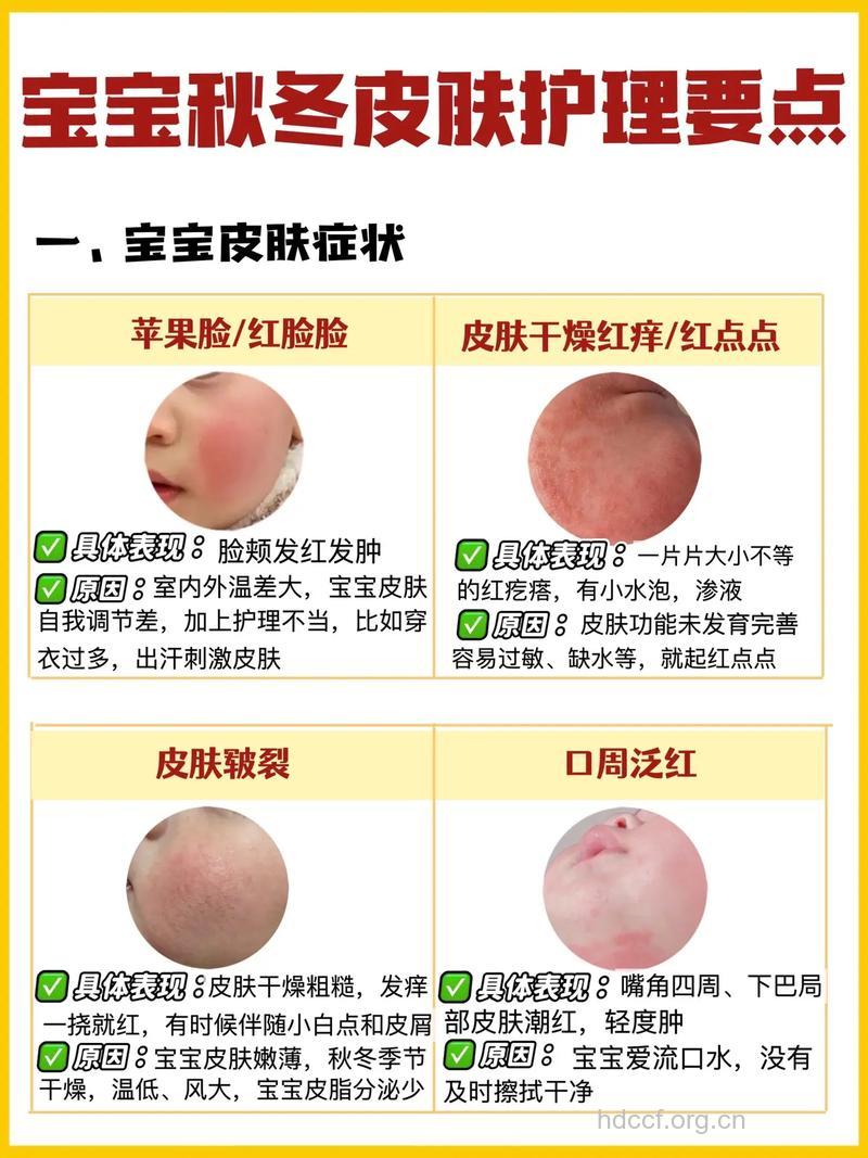 冬季宝宝皮肤干燥怎么办