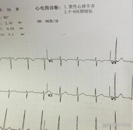 窦性心律失常的表现有哪些