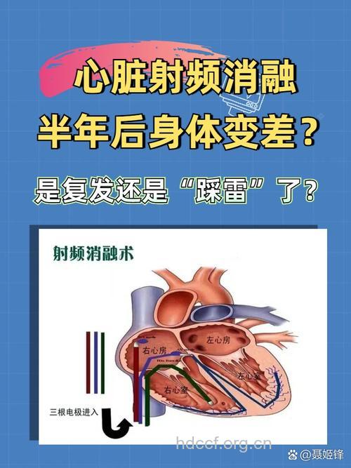 射频消融能治本——房颤