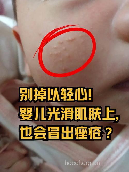 新生儿为什么会长痘痘