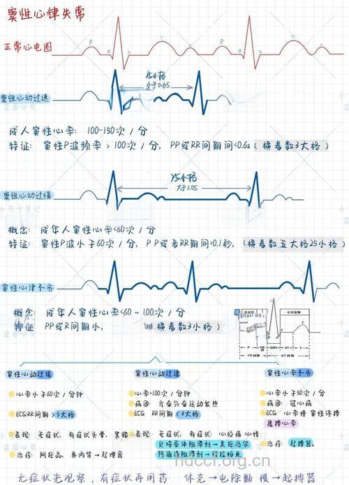 心律失常的自我辨别法