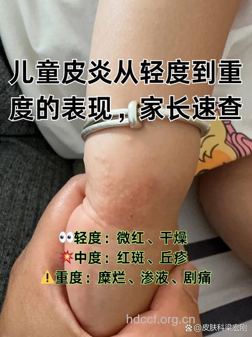 宝宝湿疹反复发作警惕特异性皮炎