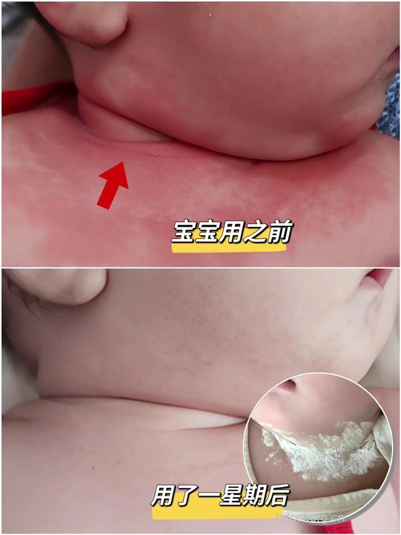 爽身粉使用不当会损害宝宝健康