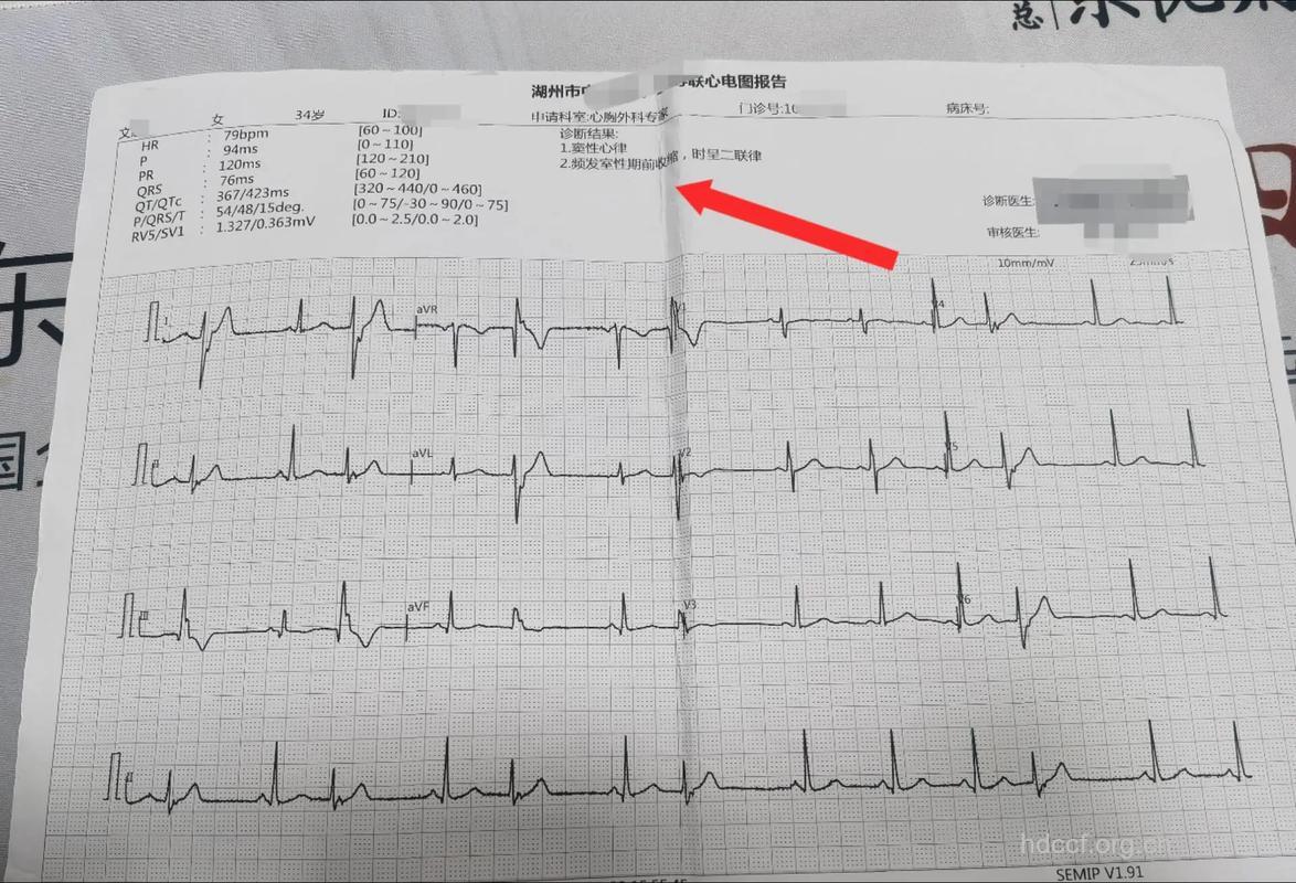 运动测验与心律失常的检查