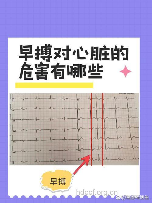 看看你是哪一种早搏？