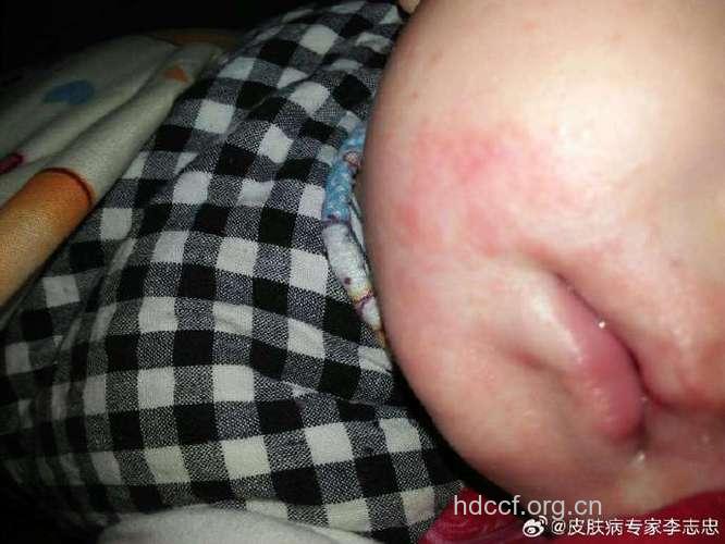 孕期吃胡萝卜 生出宝宝少湿疹