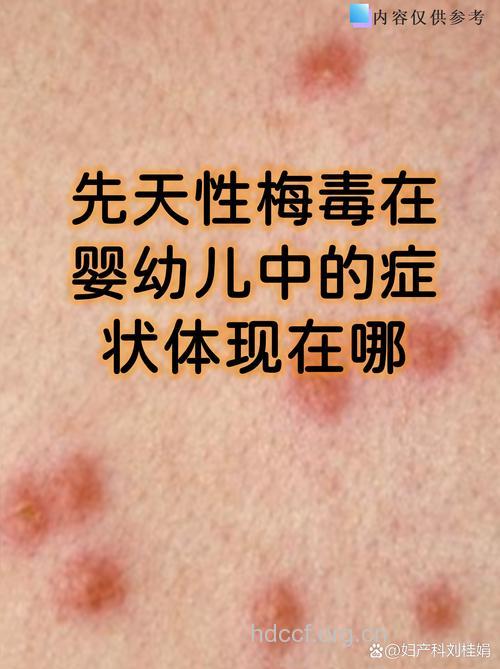 梅毒婴儿是男女性乱结果