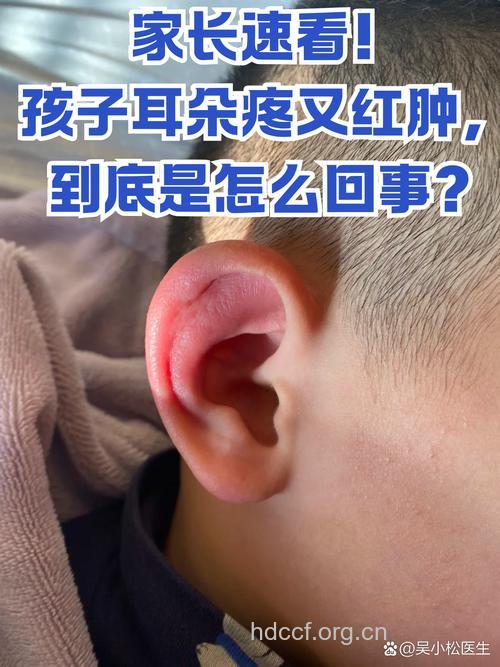 儿童夏季易出现耳朵感染