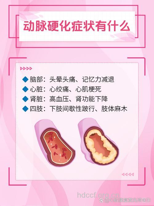 动脉硬化有哪些前期预兆 做好这些可预防