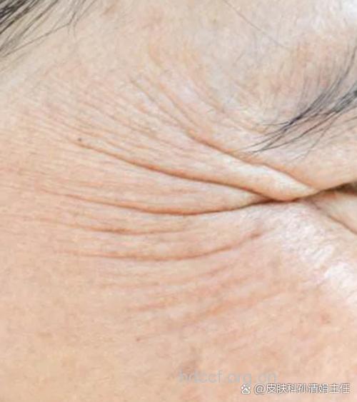 四种食物赶走你的鱼尾纹