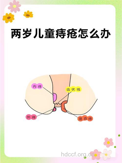 婴儿长痔疮应该怎么办?
