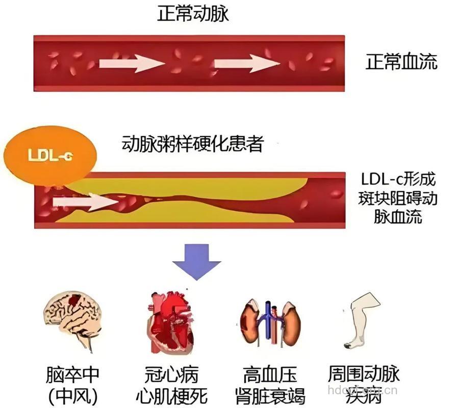 不同类型动脉硬化的表现
