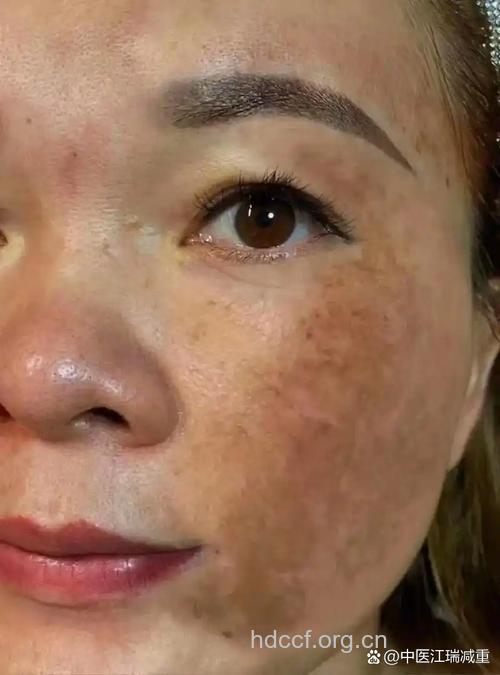 产后气血不畅易长斑