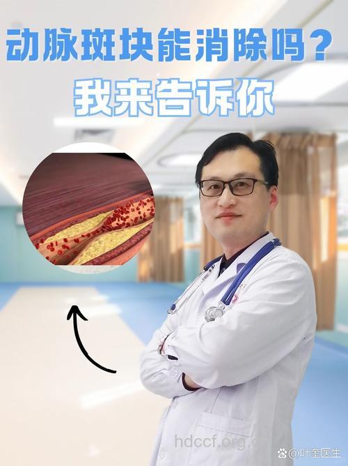 导致动脉硬化的凶手