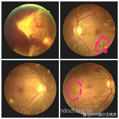 眼底动脉硬化要紧吗