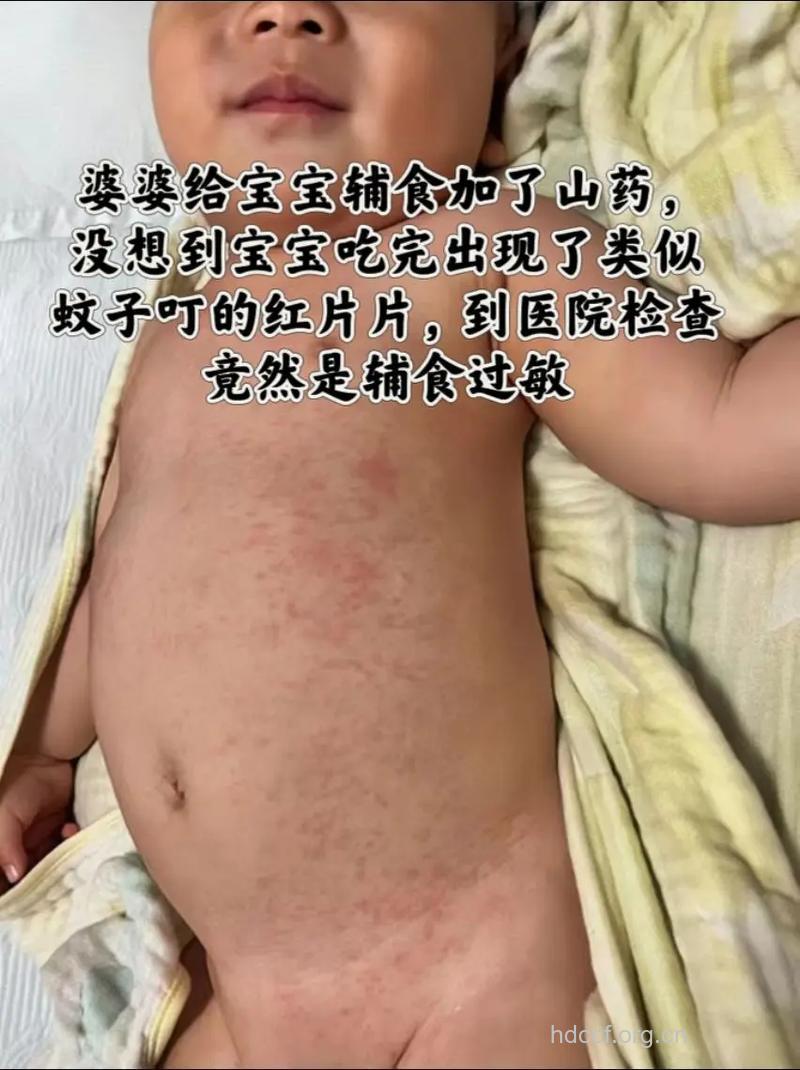 添加辅食时引起的食物过敏