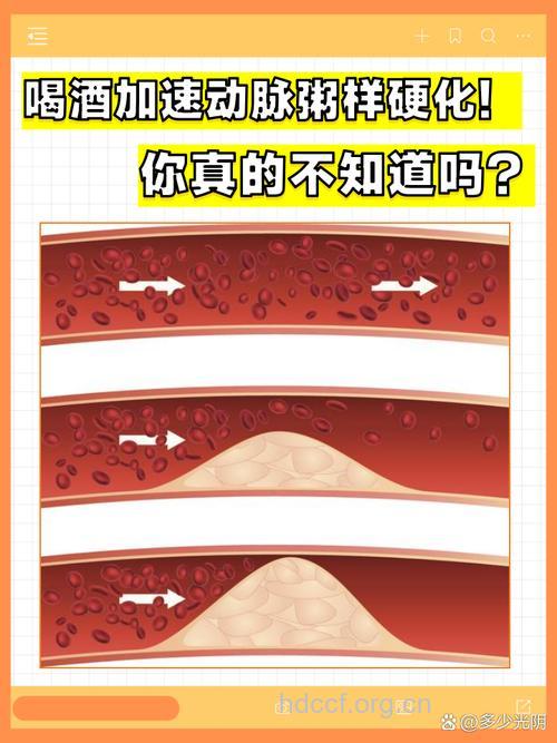 酒精可抑制动脉粥样硬化