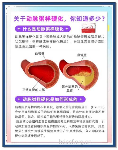 有效预防动脉粥样硬化