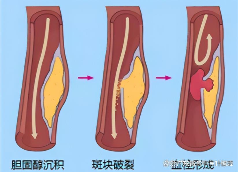 简单介绍：动脉硬化闭塞症病理变化