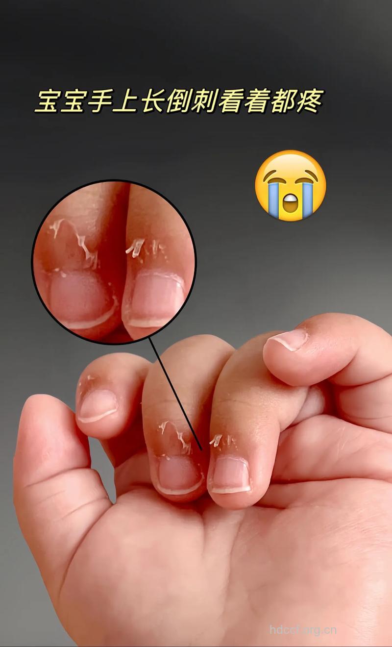 宝宝手长＂倒刺＂多吃水果