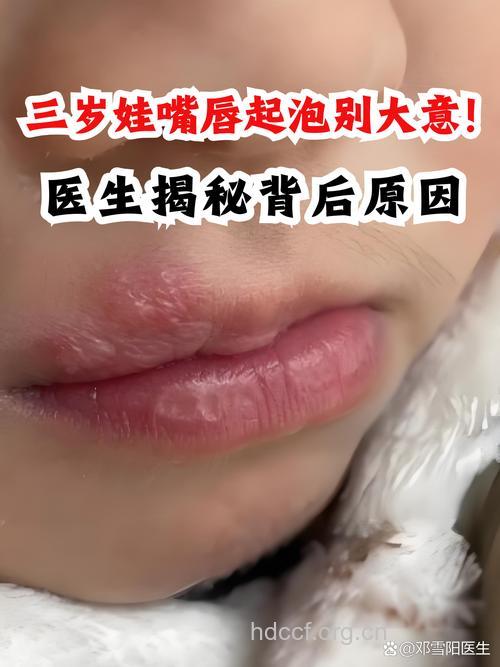 用米汤治宝宝烂嘴角