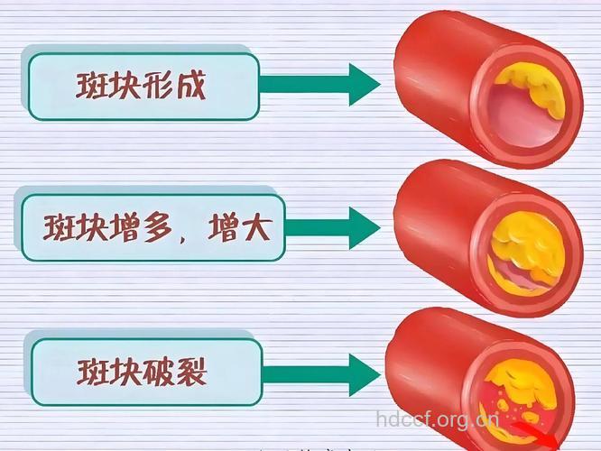 动脉硬化斑块需小心
