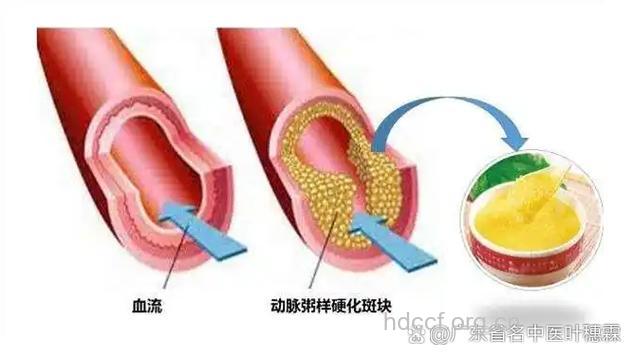 三大动脉硬化“高压区”