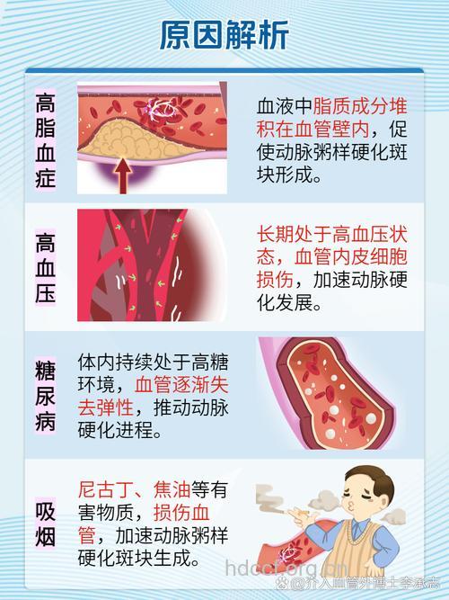 何为动脉硬化的发病因素