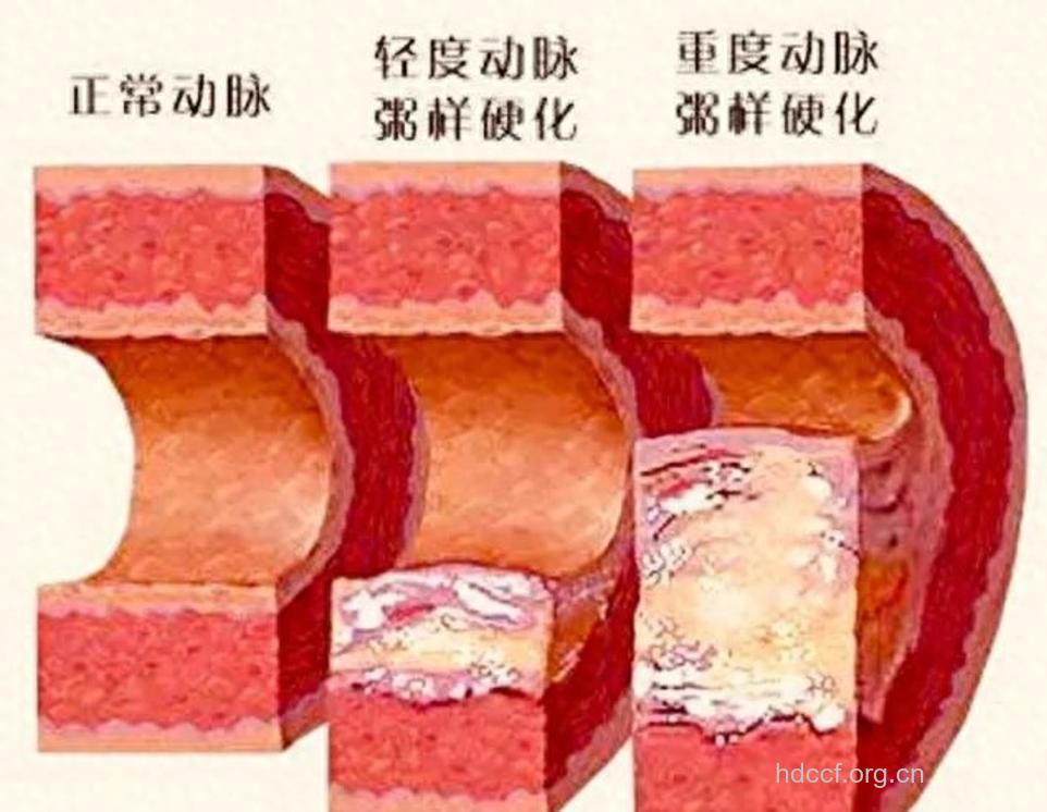 动脉硬化小心会很惨！