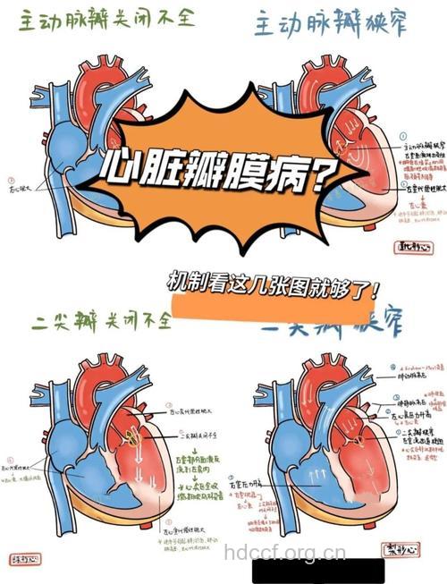 心脏瓣膜病的常见症状