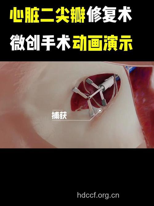 谈谈心脏瓣膜修复成形术