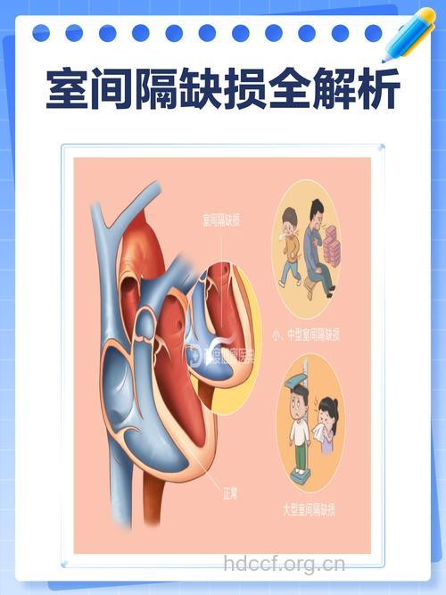 室间隔缺损的初步研究