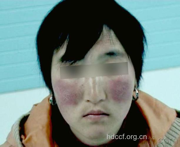 脸色暗红或为风湿性心脏病