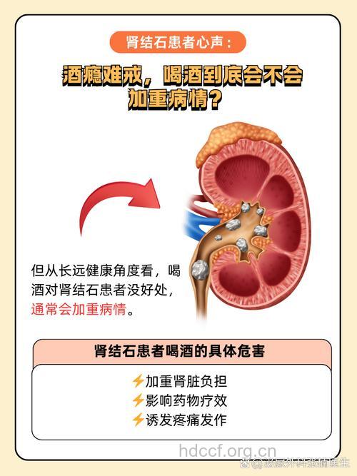 爱喝啤酒可能诱发肾结石