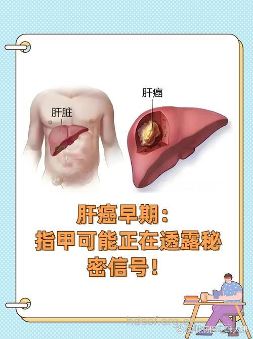 导致肝癌来袭的10大凶手