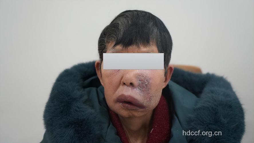 老人牙痛脸肿是什么病