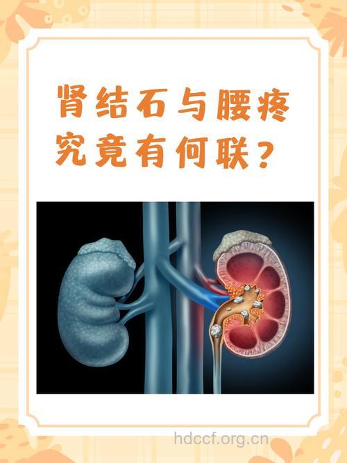 腰痛和肾结石的关系
