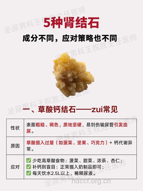 肾结石怎么进行分类呢
