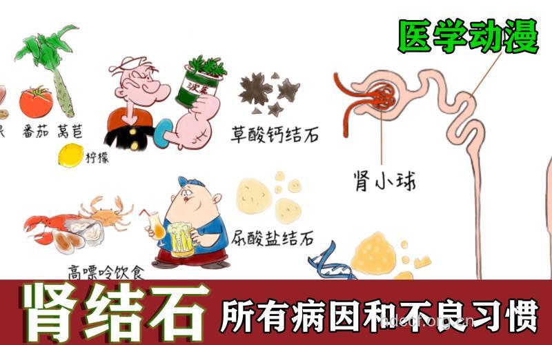 肾结石的病因有哪些