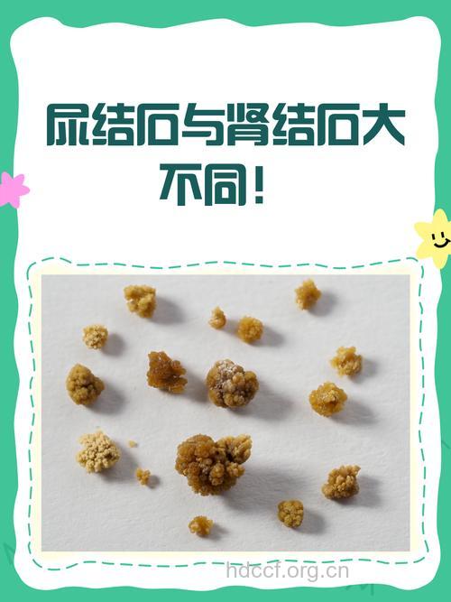 哪些疾病易与肾结石混淆