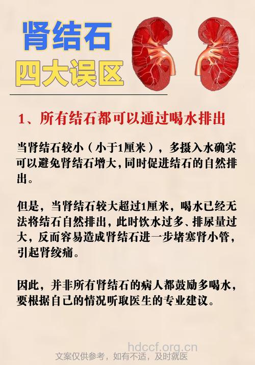 对于肾结石有哪些认识误区