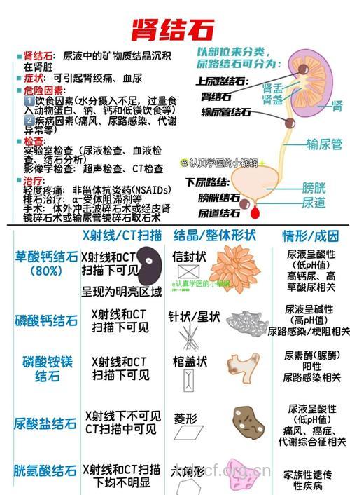 肾结石的成因你知道多少?