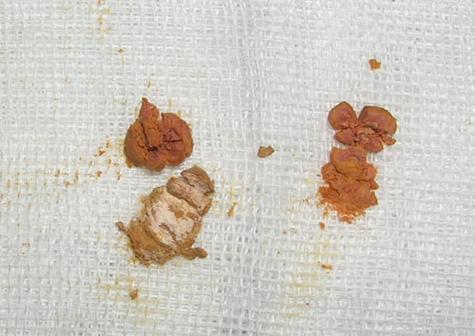 小儿肾结石不全是奶粉惹祸