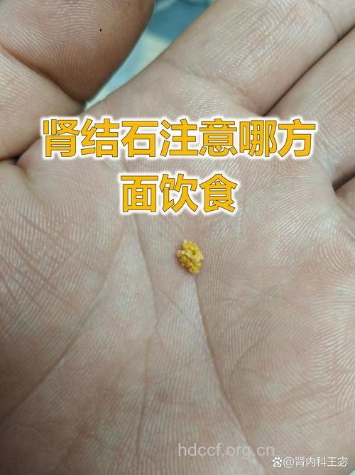 晚饭吃得晚结石来得早!