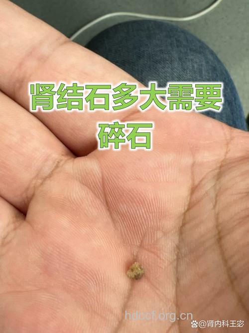而立之年谈结石