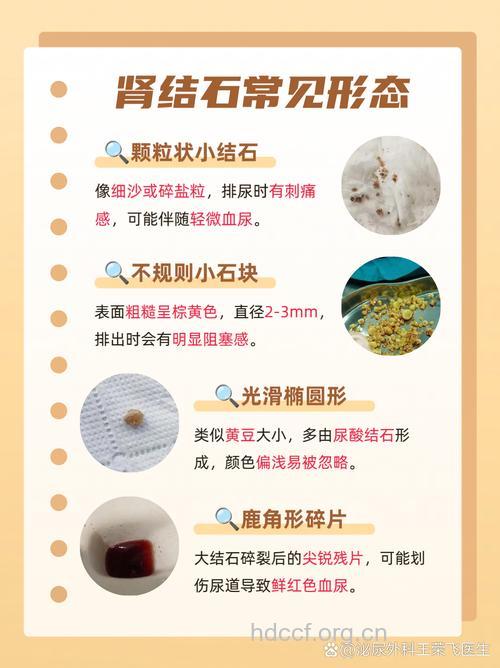 夏天 肾结石形成正当时