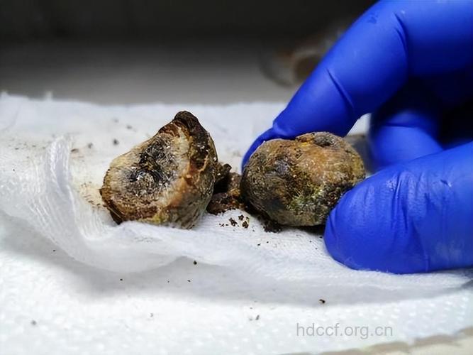 茶+奶“协力” 击碎肾结石