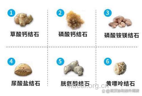 你需要知道的肾结石种类