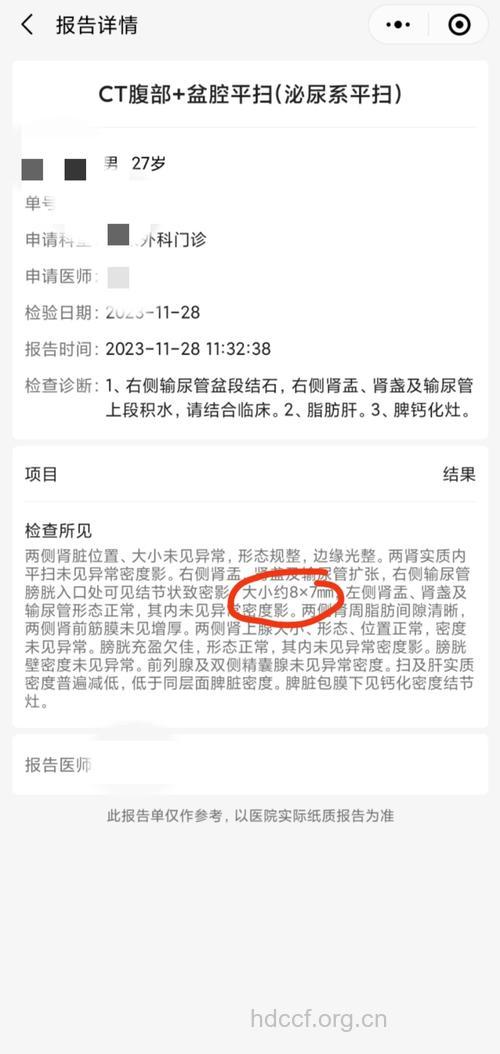 关于“大结石”新闻一则