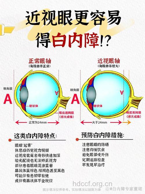 白内障不是老年人的专利